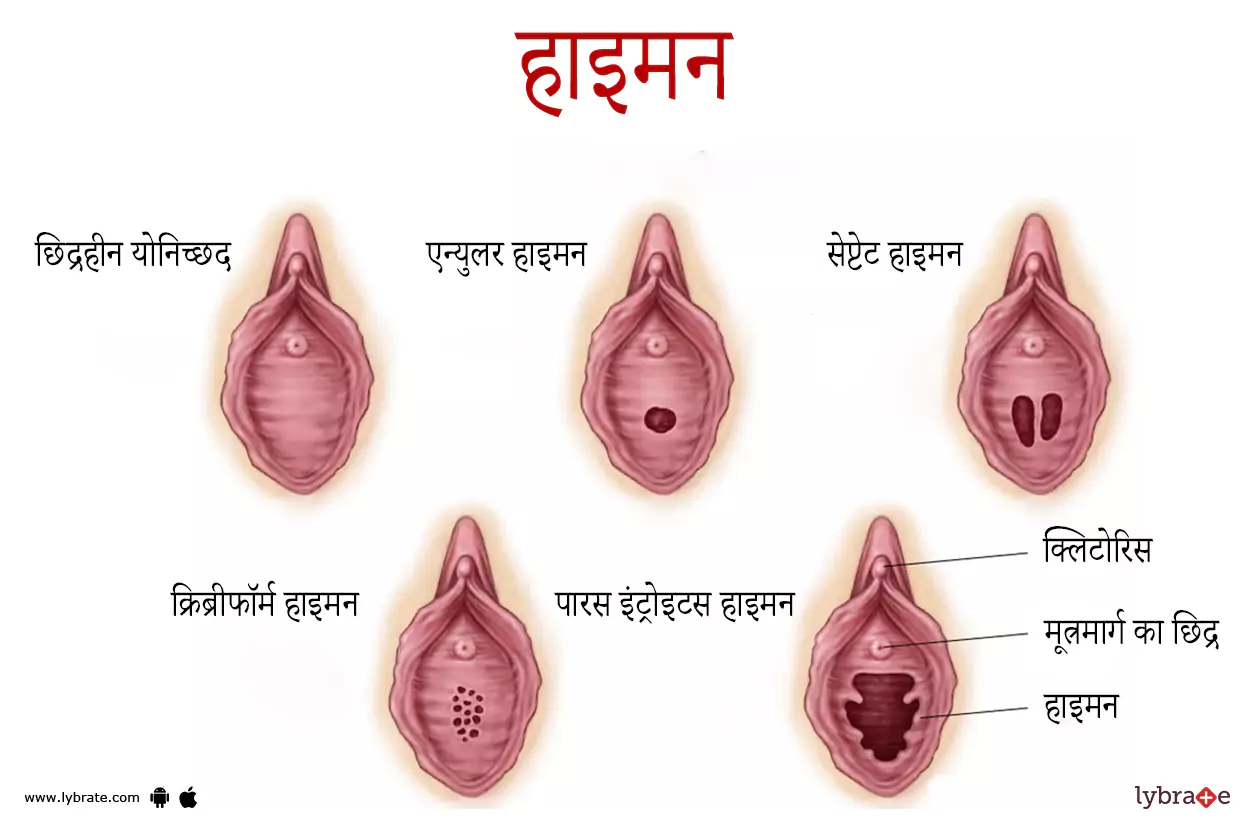 हाइमन का चित्र | Hymen Ki Image
