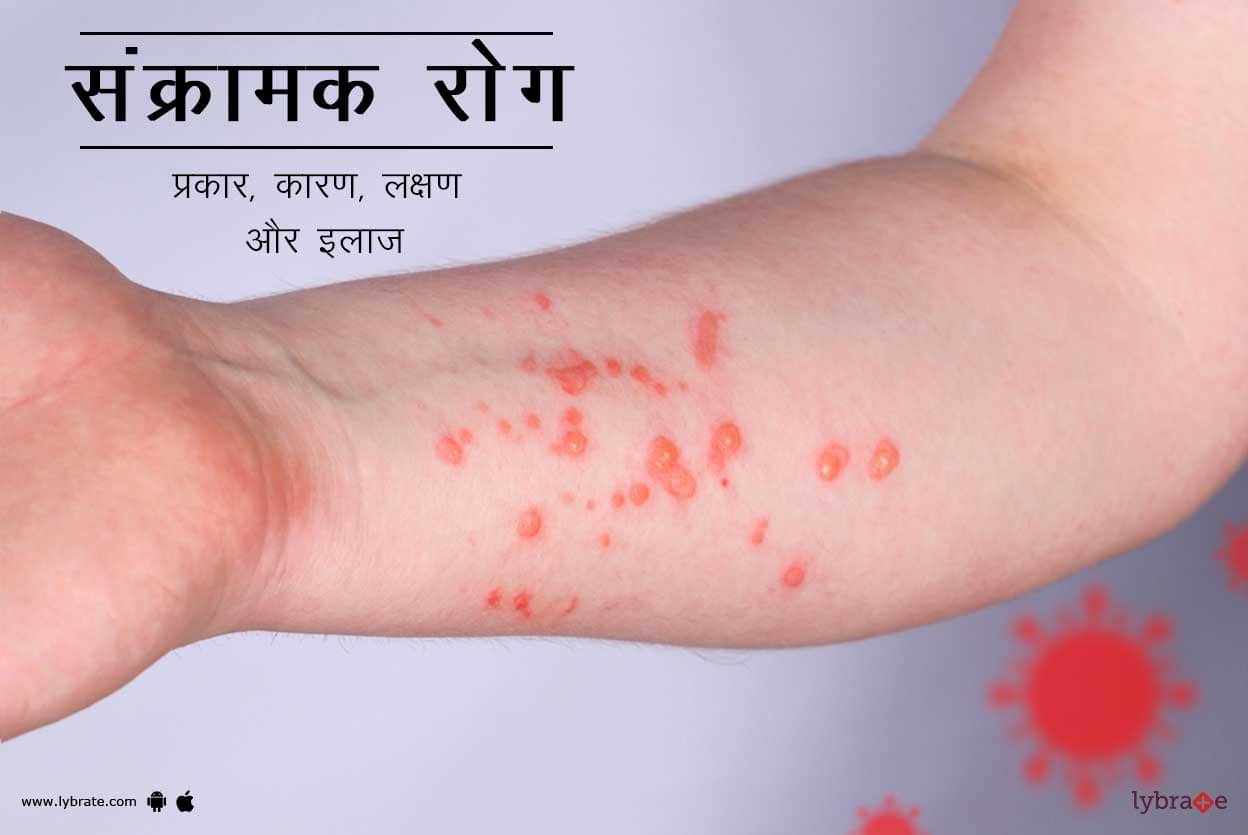 Sankramak Rog: Prakar, karan, lakshan aur ilaj | संक्रामक रोग: प्रकार, कारण, लक्षण और इलाज Sankramak Rog: Prakar, karan, lakshan aur ilaj | संक्रामक रोग: प्रकार, कारण, लक्षण और इलाज
