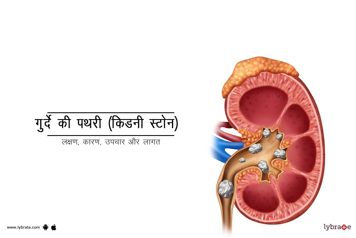 kidney-stones-in-hindi