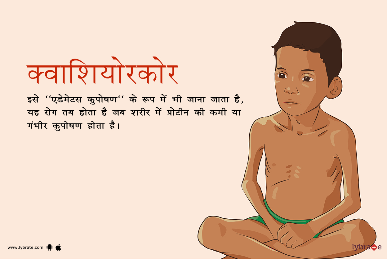 क्वाशिओरकोर क्या है?