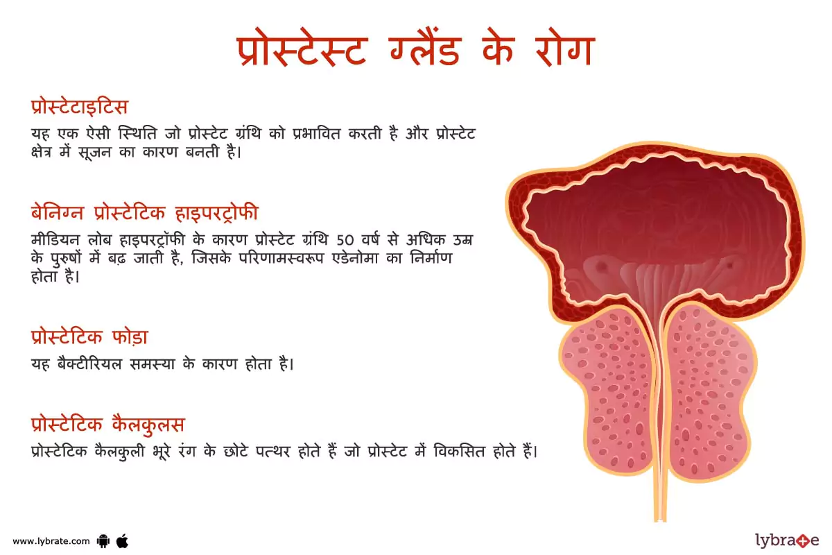 प्रोस्टेट के रोग | Prostate Ki Bimariya