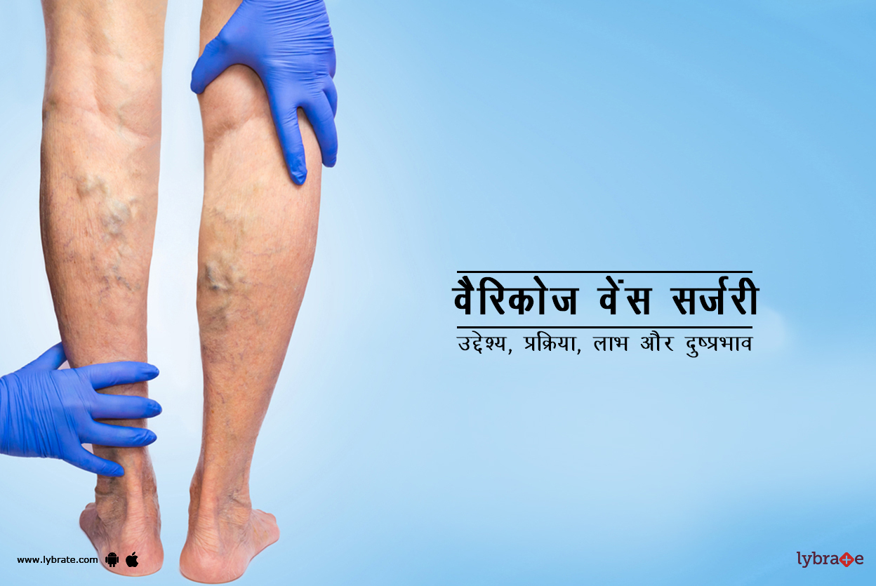 वैरिकोज वेंस सर्जरी क्या है?