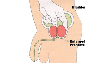 finax finasteride 1mg