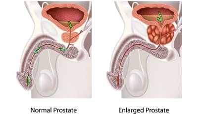 prostate wiki in hindi