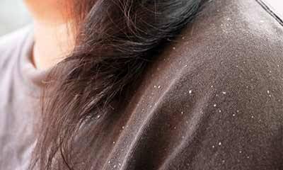 I have a ample of dandruff and my doctor suggest me to ...