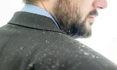 Frequently Asked Questions About Treating Dandruff Lybrate