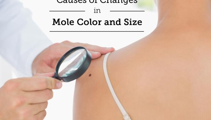 Causes of Changes in Mole Color and Size
