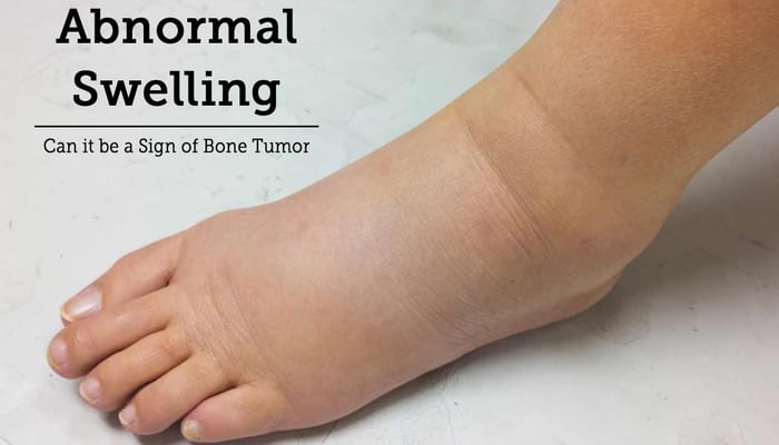 Abnormal Swelling - Can it be a Sign of Bone Tumor