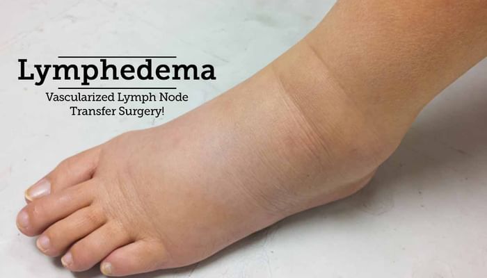 Lymphedema - Vascularized Lymph Node Transfer Surgery!