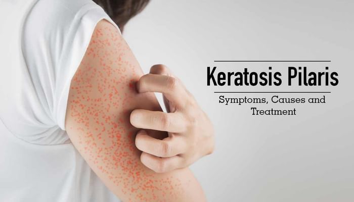 Keratosis Pilaris - Symptoms, Causes and Treatment