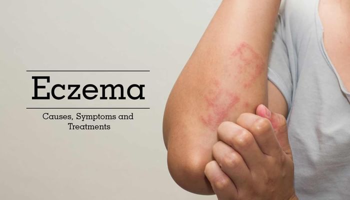 Eczema - Causes, Symptoms and Treatments
