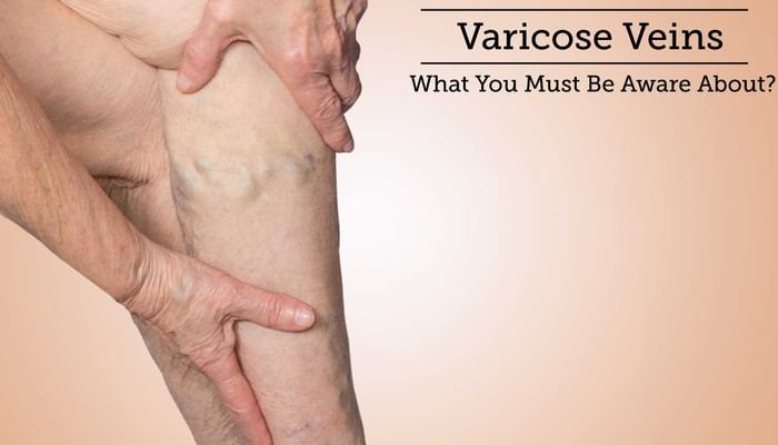 Varicose Veins - What You Must Be Aware About?