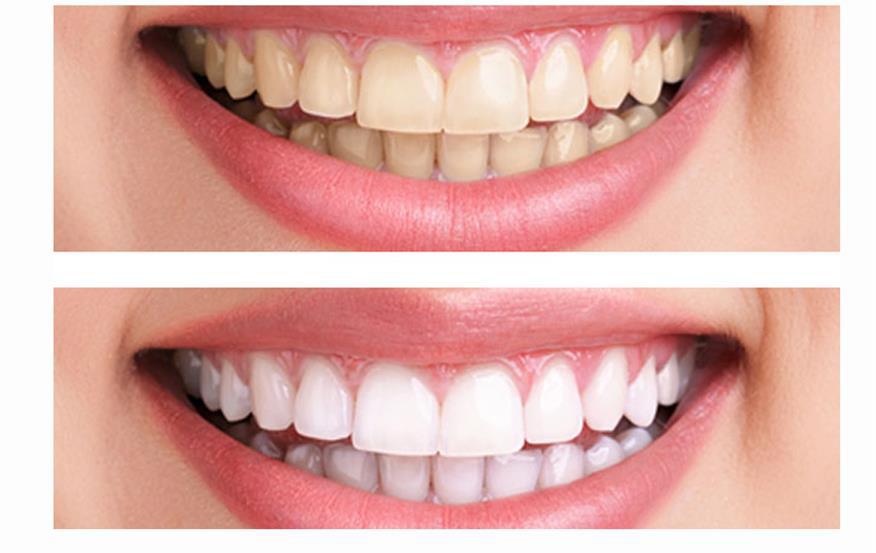 Dr. Maneet's Dental Clinic - Best Dentist In Ludhiana for RCT Braces Implants Gums Teeth Whitening Image 6