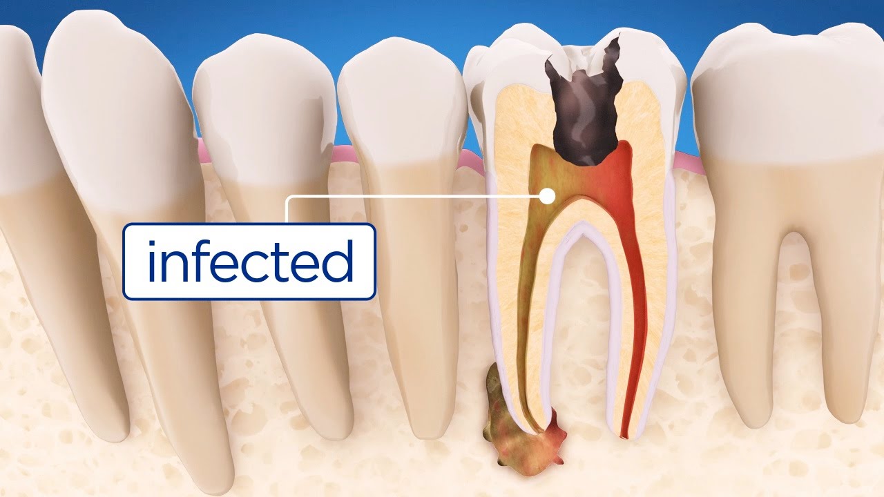 Dr. Maneet's Dental Clinic - Best Dentist In Ludhiana for RCT Braces Implants Gums Teeth Whitening Image 10