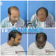 Radiance Advanced Hair Transplant Center, Hair loss, Hair fall, Treatment, Hospital, Clinic Image 8