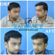 Radiance Advanced Hair Transplant Center, Hair loss, Hair fall, Treatment, Hospital, Clinic Image 7