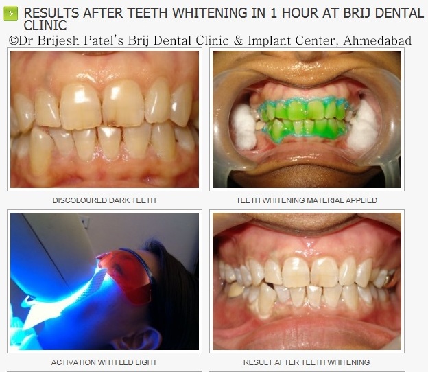 BRIJ DENTAL CLINIC & IMPLANT CENTER Image 10