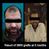 Delight Clinic - Hair Transplant,Laser & Cosmetic Surgery Centre Image 10