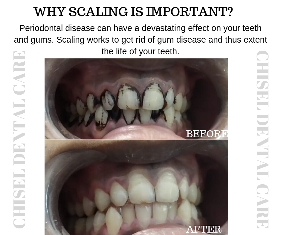 Chisel Dental Care | Orthodontic, Implant & Surgery Centre | Oral and maxillofacial Surgery | Oral Cancer Detection Centre |Orthodontic Centre | Invisalign Braces | Smile Design | Emergency Dentistry Image 1