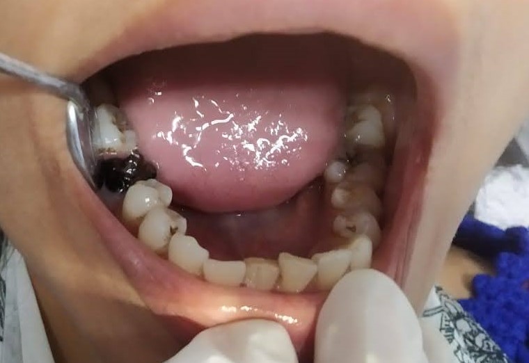Chisel Dental Care | Orthodontic, Implant & Surgery Centre | Oral and maxillofacial Surgery | Oral Cancer Detection Centre |Orthodontic Centre | Invisalign Braces | Smile Design | Emergency Dentistry Image 10