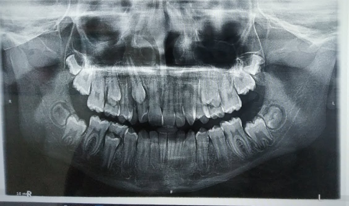 Chisel Dental Care | Orthodontic, Implant & Surgery Centre | Oral and maxillofacial Surgery | Oral Cancer Detection Centre |Orthodontic Centre | Invisalign Braces | Smile Design | Emergency Dentistry Image 7