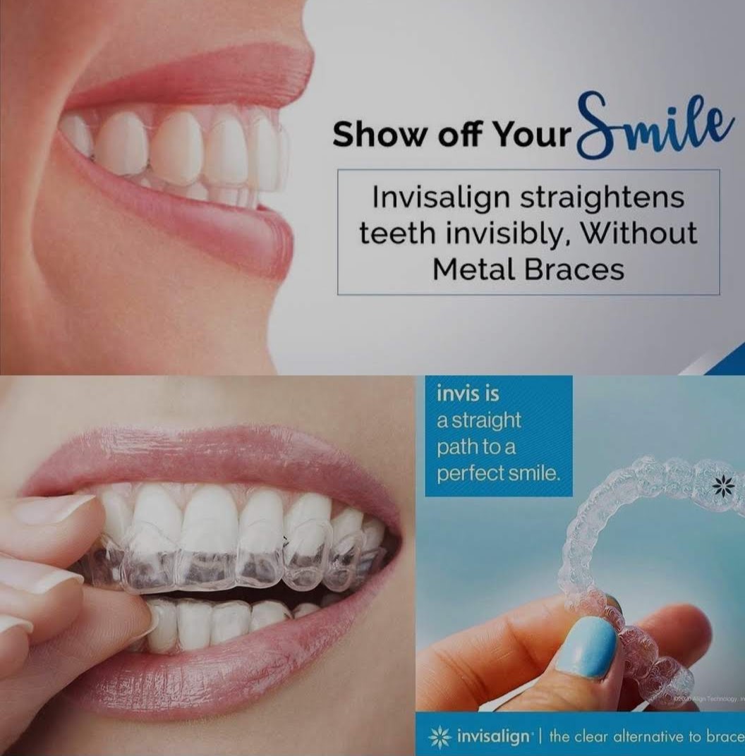 Chisel Dental Care | Orthodontic, Implant & Surgery Centre | Oral and maxillofacial Surgery | Oral Cancer Detection Centre |Orthodontic Centre | Invisalign Braces | Smile Design | Emergency Dentistry Image 8