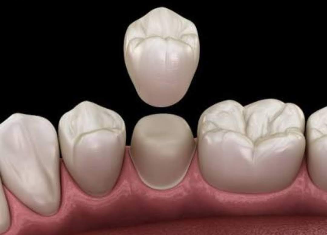 Chisel Dental Care | Orthodontic, Implant & Surgery Centre | Oral and maxillofacial Surgery | Oral Cancer Detection Centre |Orthodontic Centre | Invisalign Braces | Smile Design | Emergency Dentistry Image 6