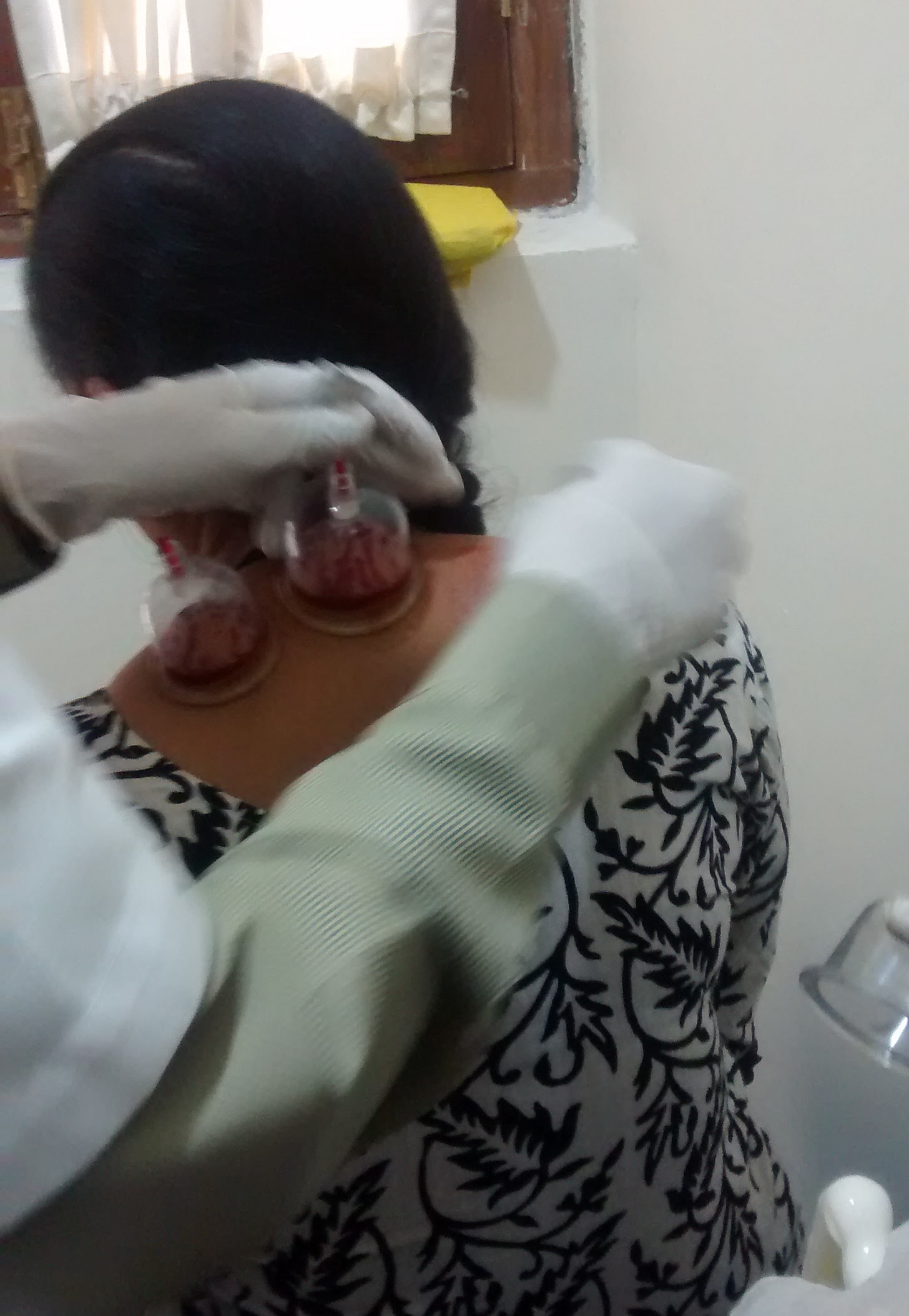 Cupping therapy in Delhi Image 4