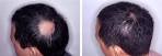 Dr.JosyJoy's online homeopathic consultation and treatment bangalore for thyroid hairfall piles infertility cholesterol skin diabetes ovary cyst irregular periods gastritis arthritis ulsoor bangalore mysore india Image 8