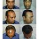 Hair Harmony & You Specialist In Hair Transplant Image 10
