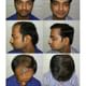 Hair Harmony & You Specialist In Hair Transplant Image 7