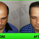 Hair Harmony & You Specialist In Hair Transplant Image 5