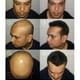 Hair Harmony & You Specialist In Hair Transplant Image 9