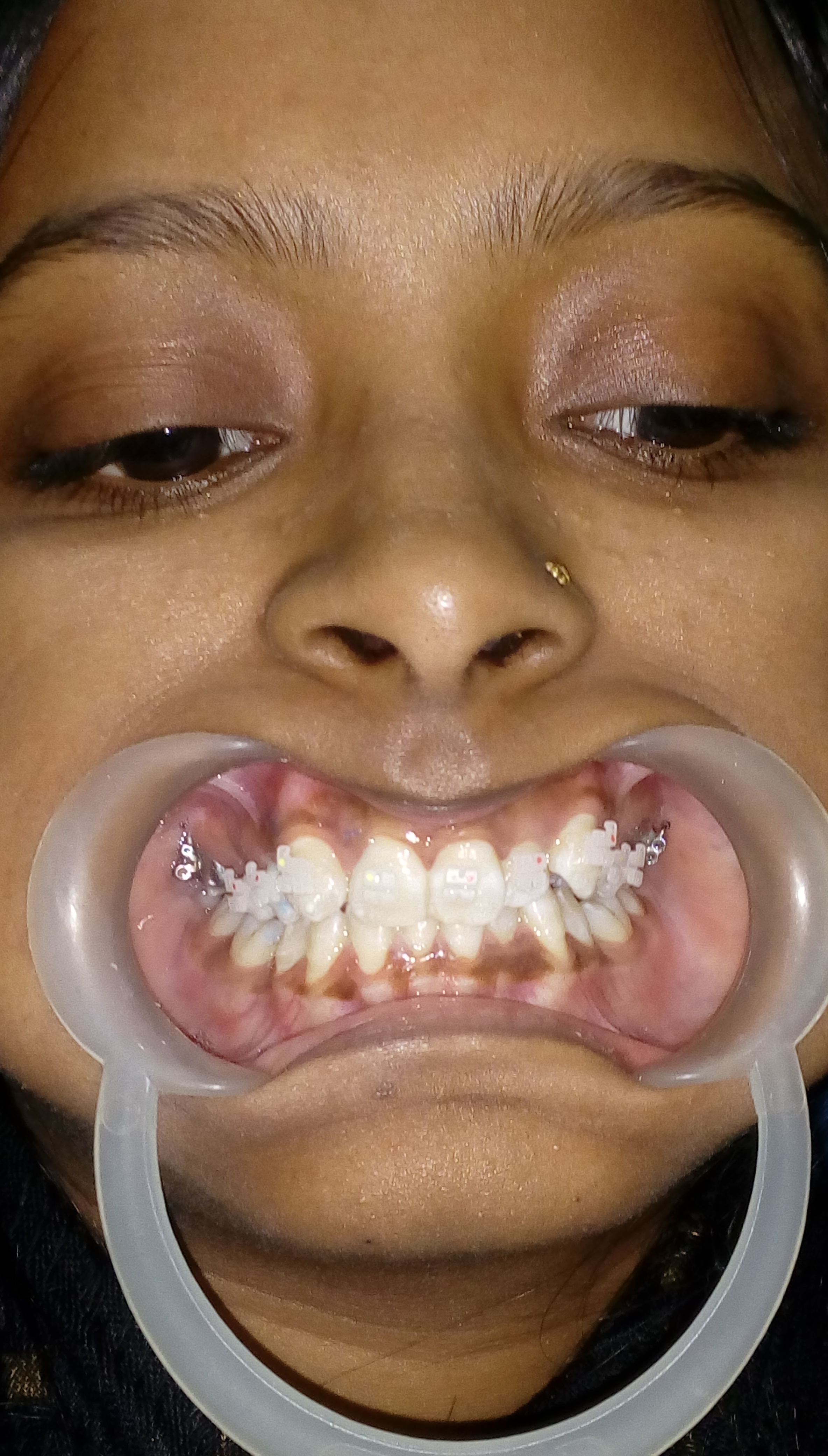 Manyalok Super Speciality - Orthodontics Implant & Pediatric Dentistry Image 5