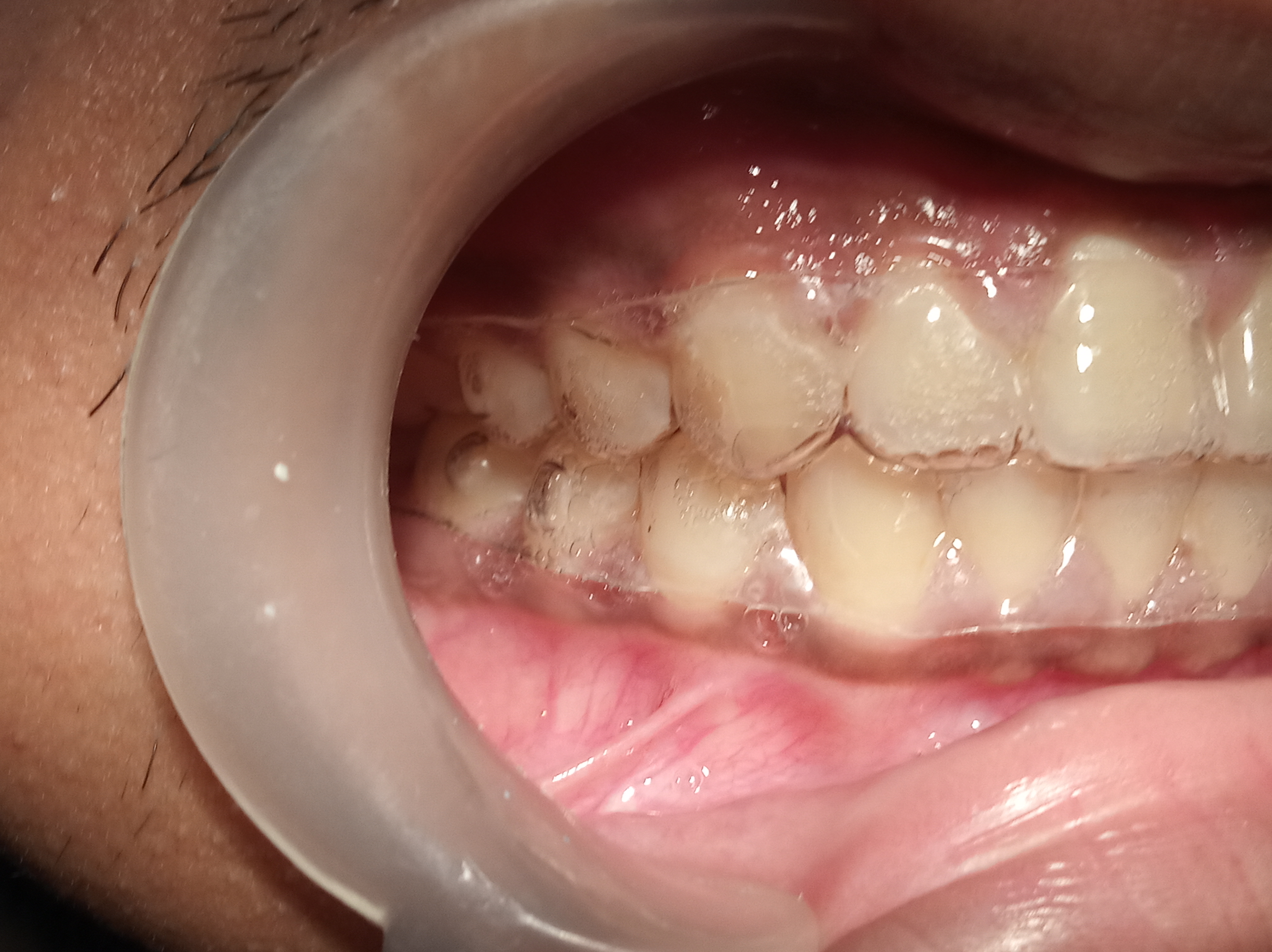 Manyalok Super Speciality - Orthodontics Implant & Pediatric Dentistry Image 6