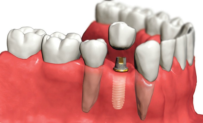 Manyalok Super Speciality - Orthodontics Implant & Pediatric Dentistry Image 8