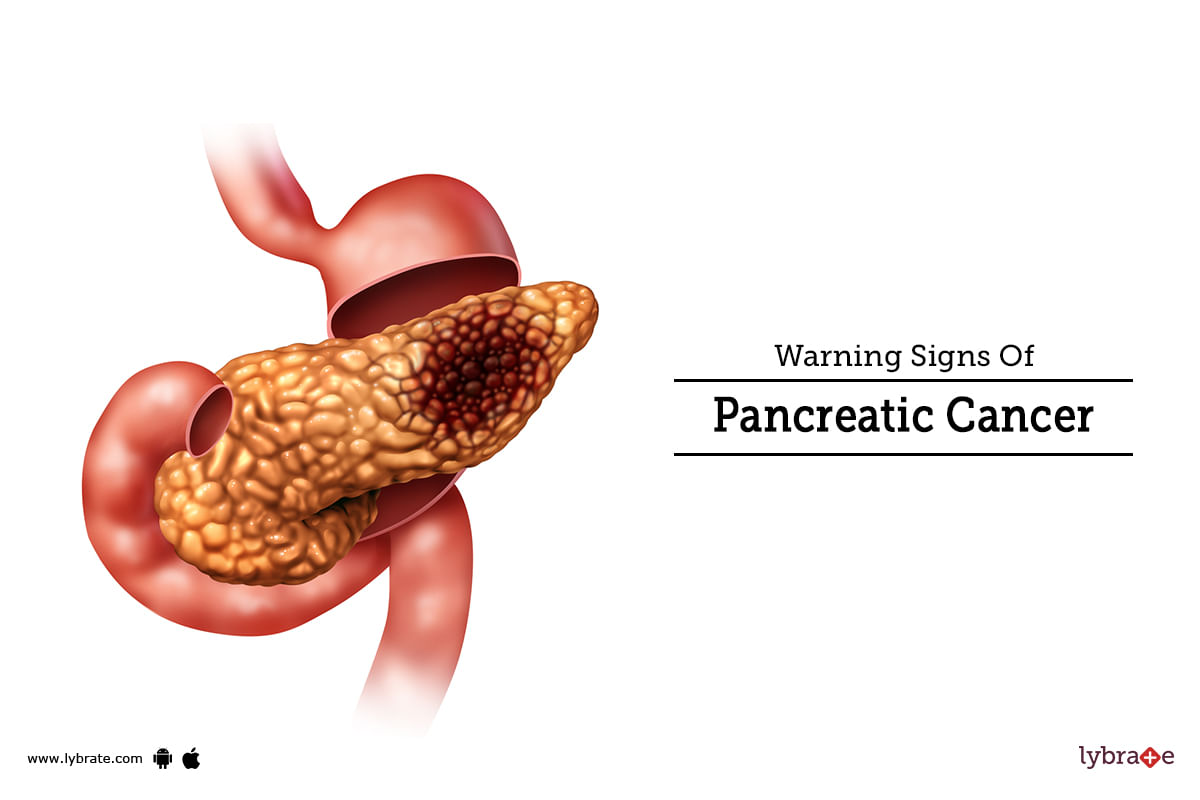 Warning Signs Of Pancreatic Cancer - By Dr. Garima | Lybrate