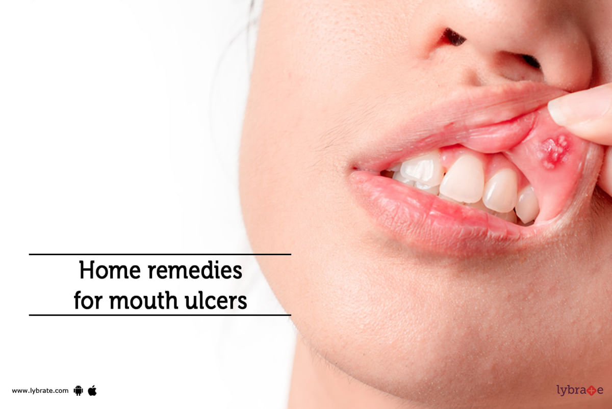 home-remedies-for-mouth-ulcers-by-dr-bindiya-r-patel-lybrate