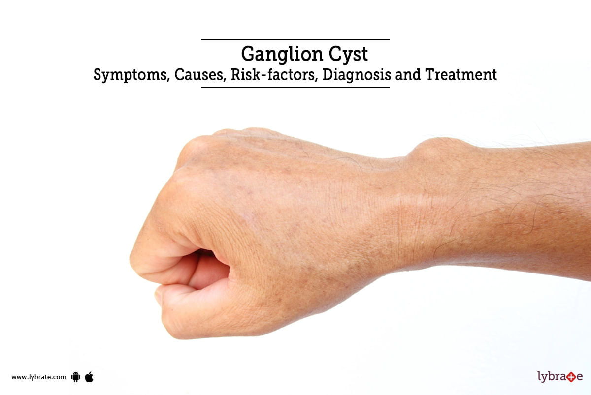 Ganglion Cyst Symptoms Causes Risk Factors Diagnosis And Treatment