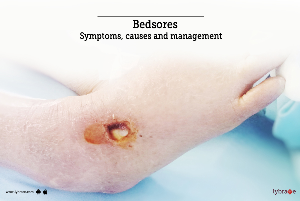 Bedsores Symptoms, causes and management By Dr. Mohammed Rihas Lybrate