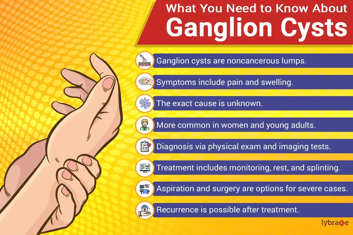 ganglion-cyst-mississauga-and-milton-chiropractor-and-physiotherapy