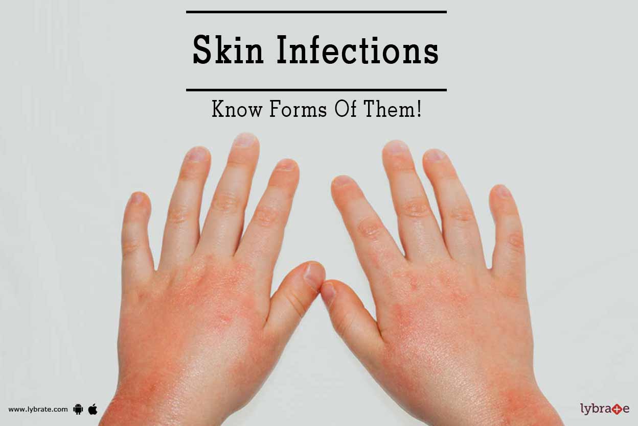 Skin Infections - Know Forms Of Them! - By Dr. Shruti Agarwal | Lybrate