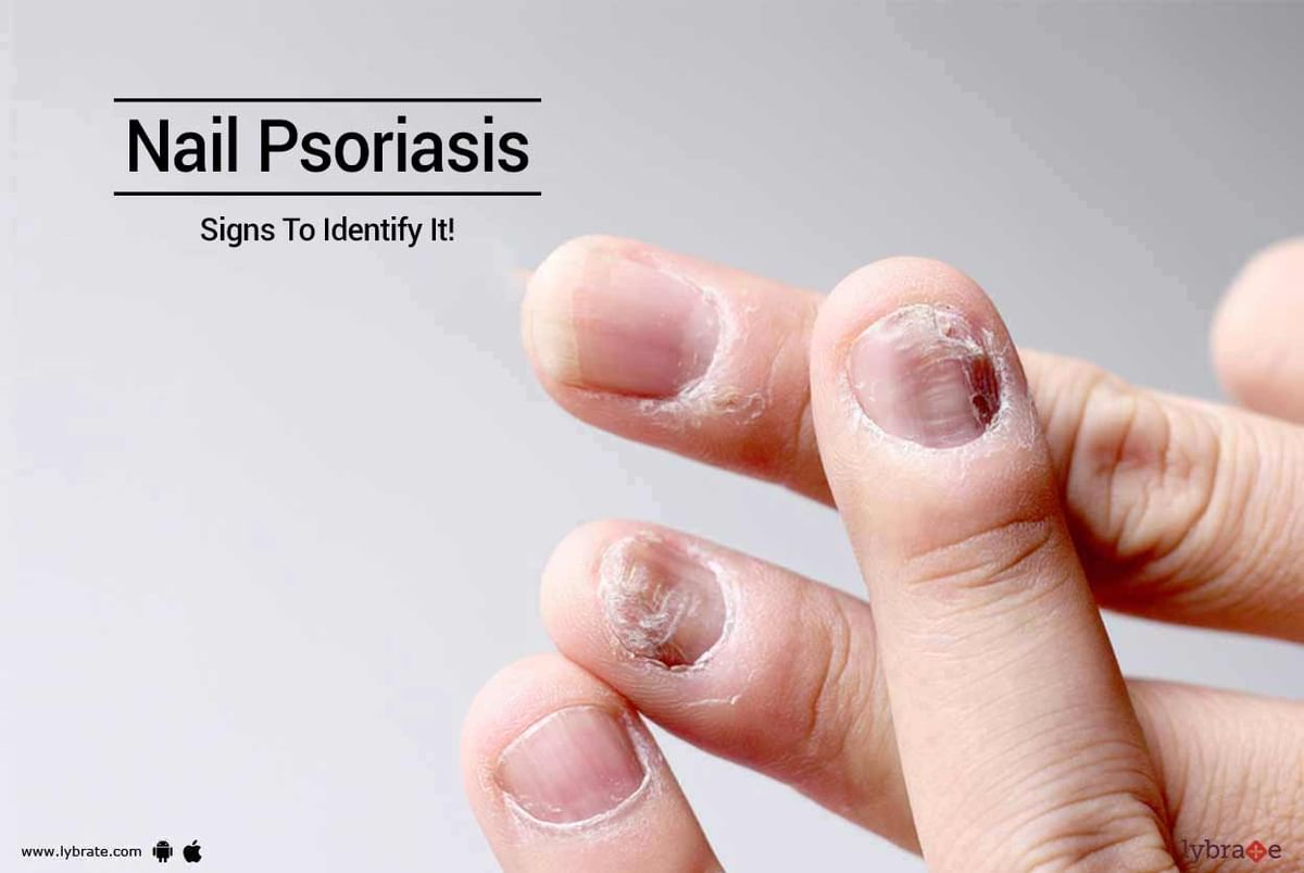 Psoriasis on the nails - Mayo Clinic