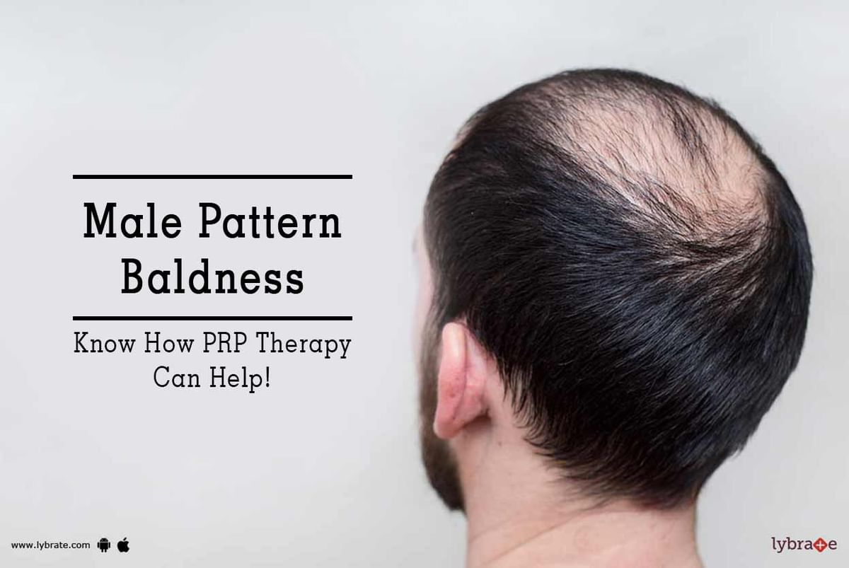 Male Pattern Baldness - Know How PRP Therapy Can Help! - By Dr. Shaurya  Rohatgi | Lybrate