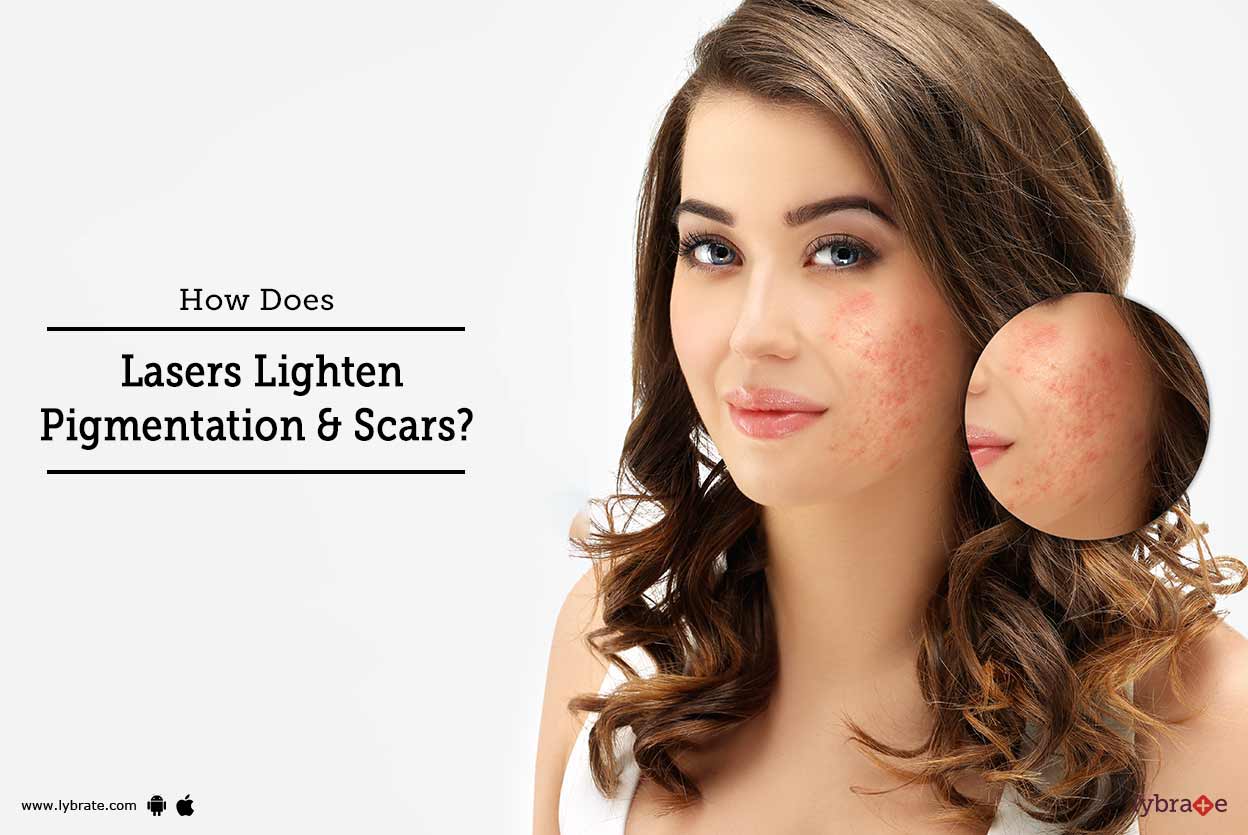 How Does Lasers Lighten Pigmentation & Scars? By Isaac International Skin & Anti Ageing