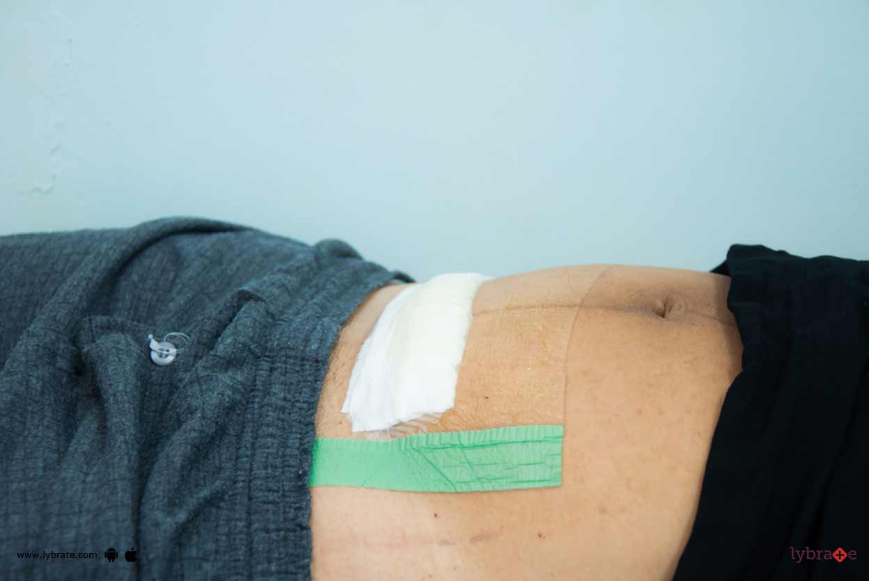 CSection Stitches Ways To Deal With Them! By Dr. Tripti Raheja