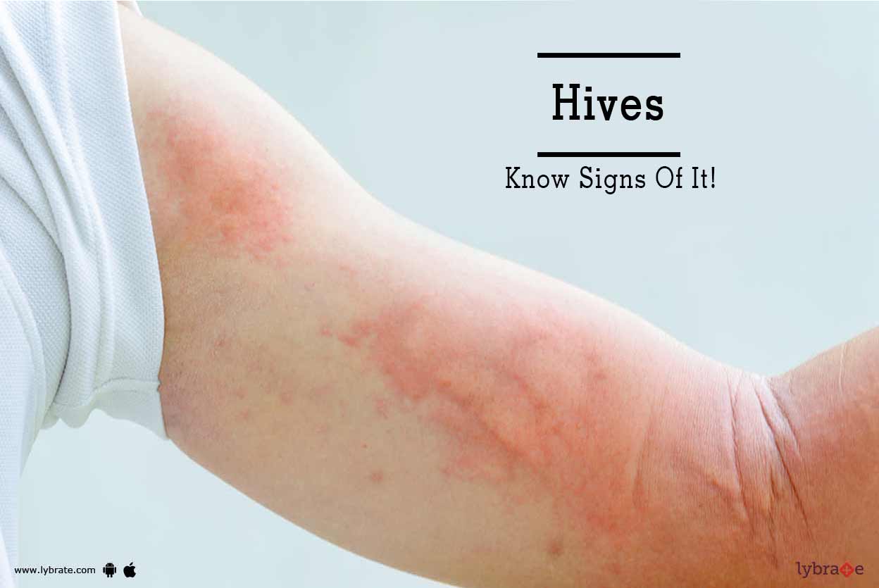 Hives Know Signs Of It! By Dr. Priyanka Gupta Lybrate