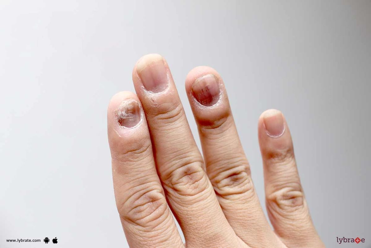 Fungal Nail Infection - Know Symptoms Of It! - By Abhivrit Aesthetics ...