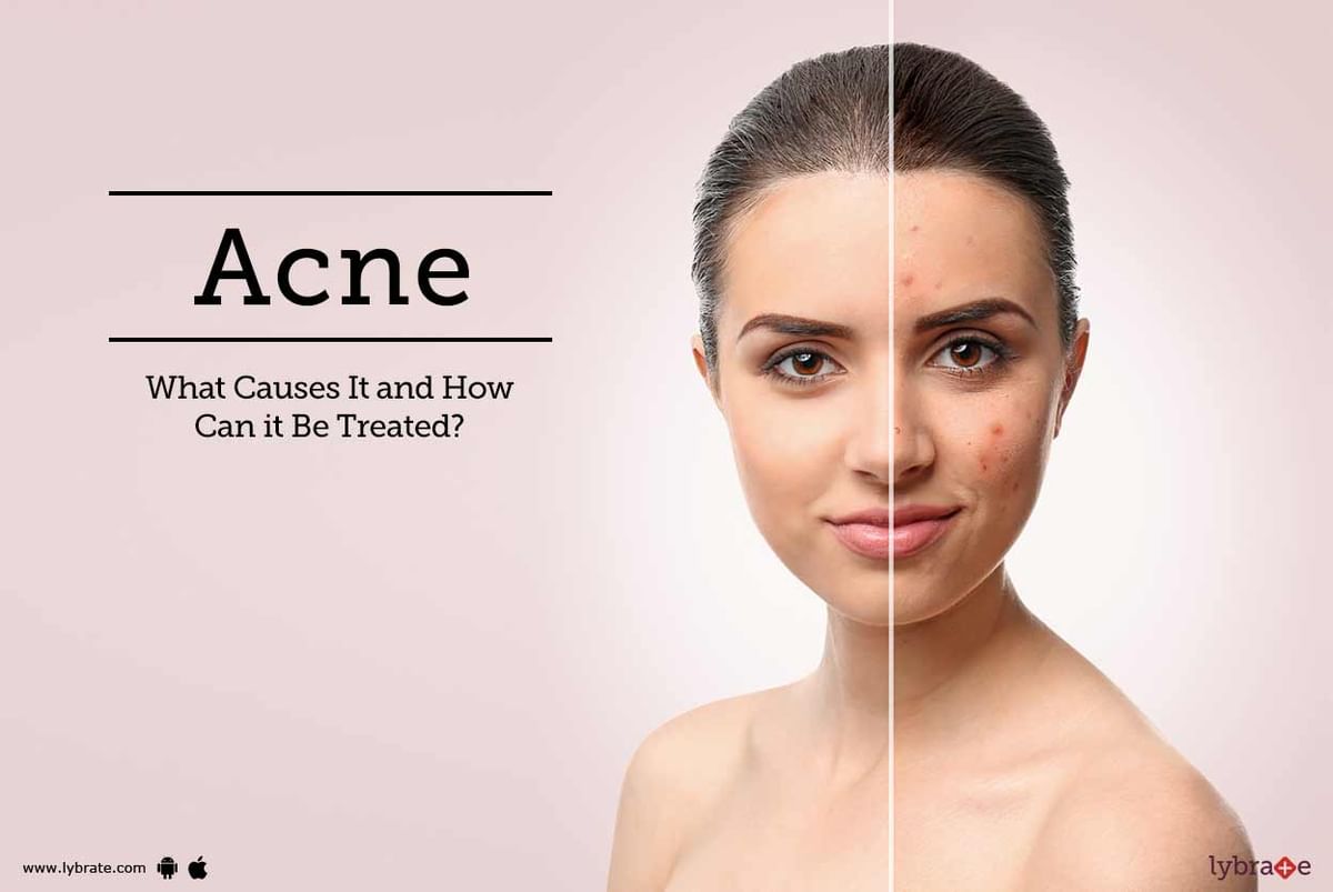 Acne: What Causes It And How Can It Be Treated? - By Dr. Sandeep Gupta 