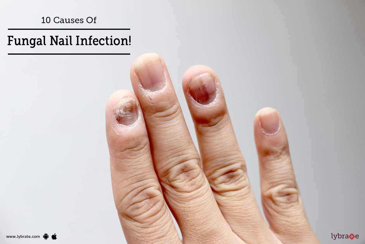 Premium Vector | Nail diseases onychomycosis causes of fungal nail infection  medical infographic design